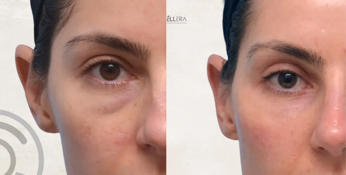 Fillers Ojeras